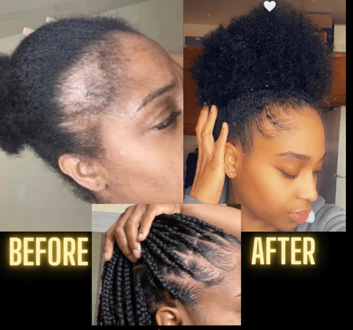 ✨HOT SALE 50% OFF🔥 Scalp Stimulator | Hair Growth Serum Oil